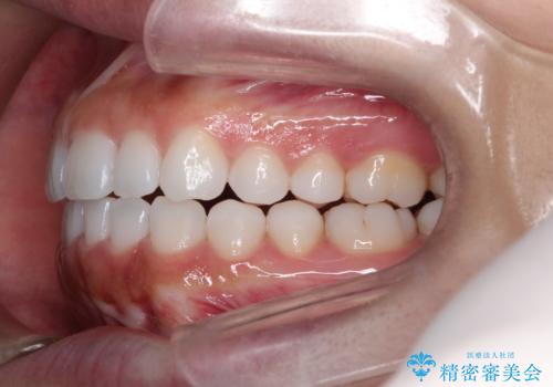 インビザラインを用いた叢生(歯並びのガタつき)の治療の治療後