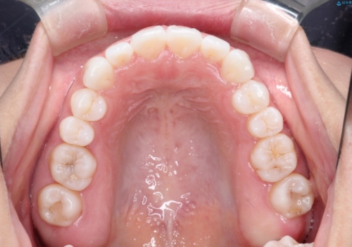 インビザラインを用いた叢生(歯並びのガタつき)の治療の治療後