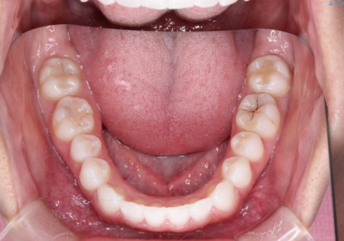 インビザラインを用いた叢生(歯並びのガタつき)の治療の治療後