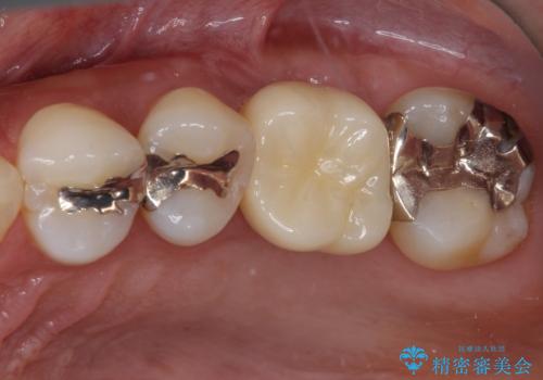 抜歯になった虫歯　奥歯のインプラント治療