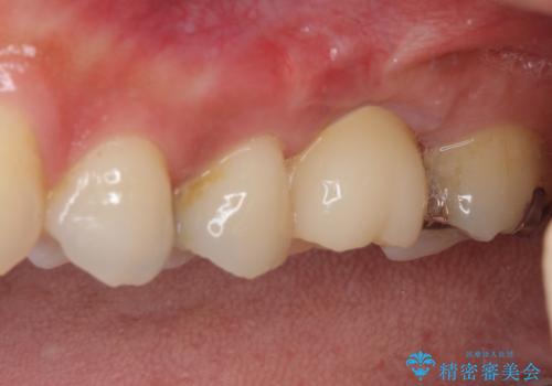 抜歯になった虫歯　奥歯のインプラント治療の治療後