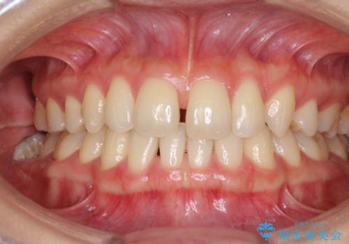 抜歯矯正の後戻りによるすきっ歯をインビザラインでの症例 治療前