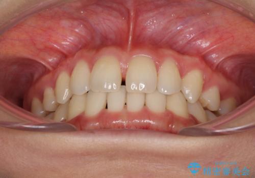 抜歯矯正の後戻りによるすきっ歯をインビザラインでの治療前