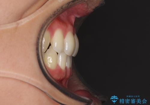 抜歯矯正の後戻りによるすきっ歯をインビザラインでの治療前