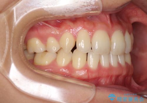 抜歯矯正の後戻りによるすきっ歯をインビザラインでの治療前