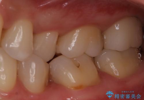 虫歯をセラミックで治療の治療後