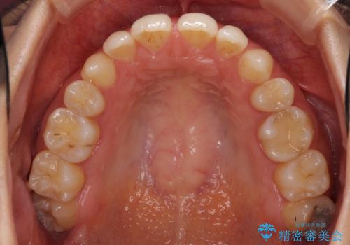 抜歯矯正の後戻りによるすきっ歯をインビザラインでの治療前