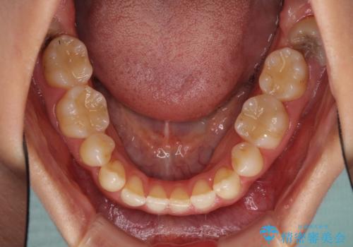 抜歯矯正の後戻りによるすきっ歯をインビザラインでの治療前
