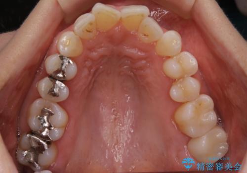 虫歯をセラミックで治療の治療後