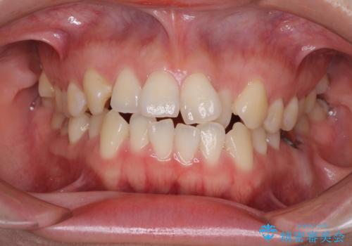 前歯のデコボコを治したい ワイヤー矯正の症例 治療前