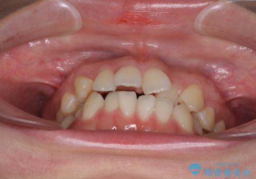 前歯のデコボコを治したい ワイヤー矯正の治療前