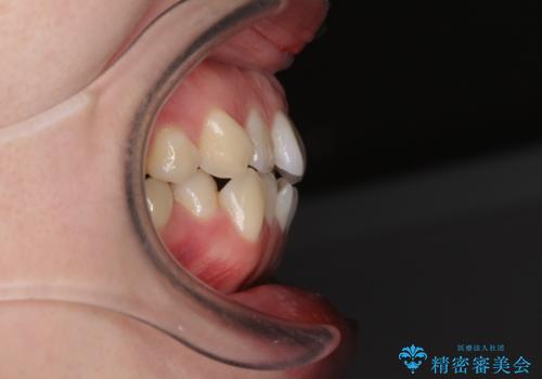 前歯のデコボコを治したい ワイヤー矯正の治療前