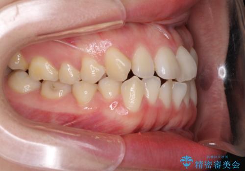 前歯のデコボコを治したい ワイヤー矯正の治療前