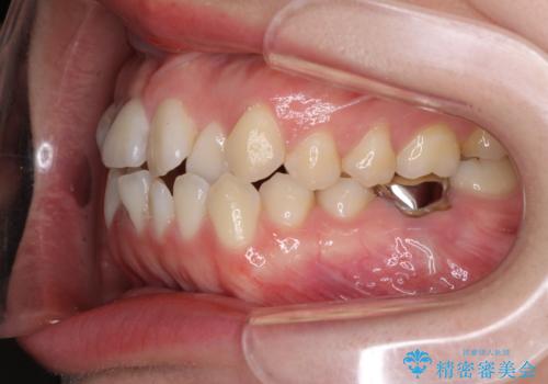 前歯のデコボコを治したい ワイヤー矯正の治療前