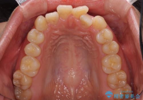 前歯のデコボコを治したい ワイヤー矯正の治療前