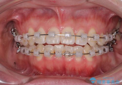 前歯のデコボコを治したい ワイヤー矯正の治療中