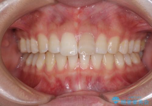 気になる前歯を治したい インビザライン矯正とオールセラミッククラウンの治療前