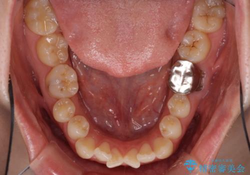 前歯のデコボコを治したい ワイヤー矯正の治療前