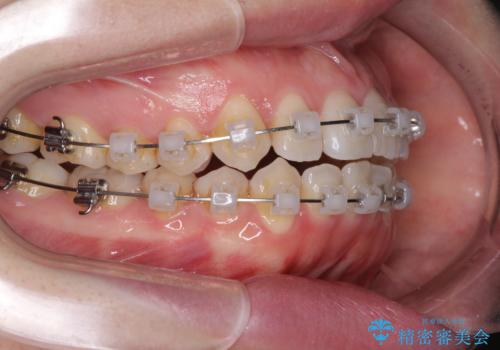 前歯のデコボコを治したい ワイヤー矯正の治療中