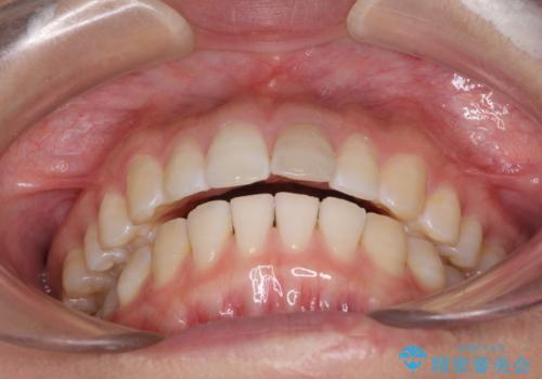 気になる前歯を治したい インビザライン矯正とオールセラミッククラウンの治療前