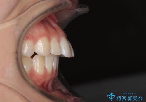 気になる前歯を治したい インビザライン矯正とオールセラミッククラウンの治療前