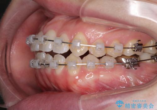 前歯のデコボコを治したい ワイヤー矯正の治療中