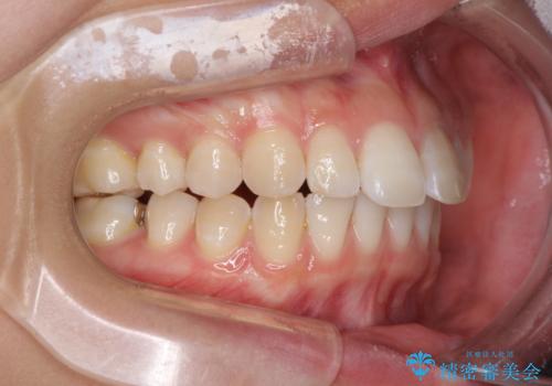 気になる前歯を治したい インビザライン矯正とオールセラミッククラウンの治療前