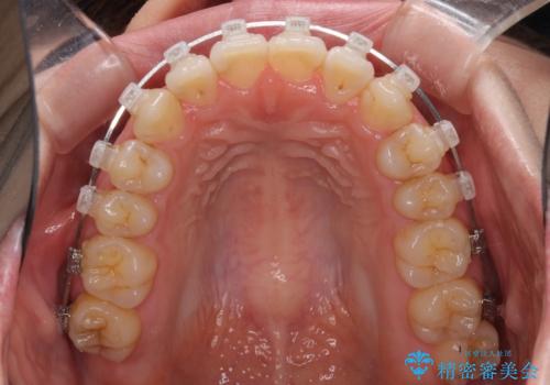 前歯のデコボコを治したい ワイヤー矯正の治療中