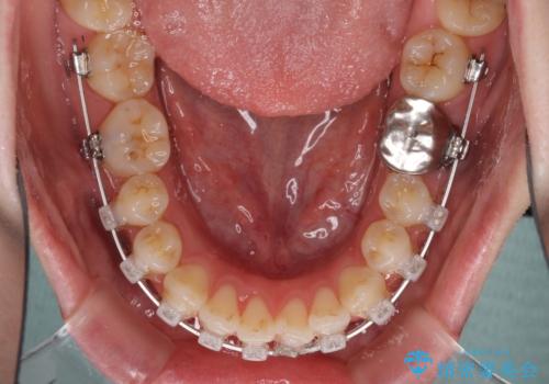前歯のデコボコを治したい ワイヤー矯正の治療中