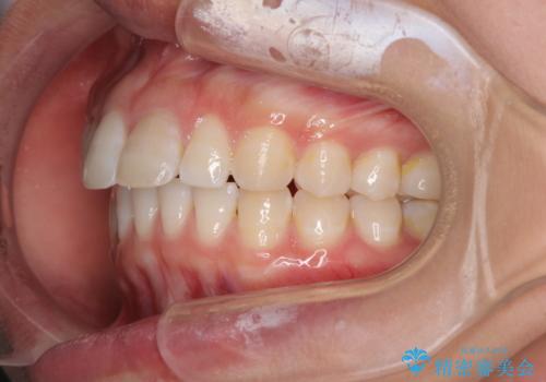 気になる前歯を治したい インビザライン矯正とオールセラミッククラウンの症例 治療前