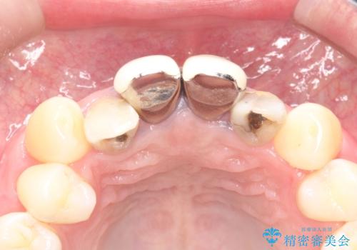 前歯の見た目が気になる　矯正・セラミックを組み合わせた治療の治療前