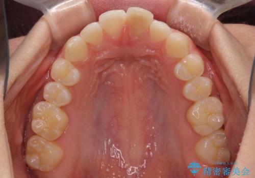 気になる前歯を治したい インビザライン矯正とオールセラミッククラウンの治療前