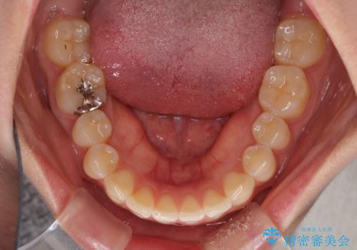 気になる前歯を治したい インビザライン矯正とオールセラミッククラウンの治療前