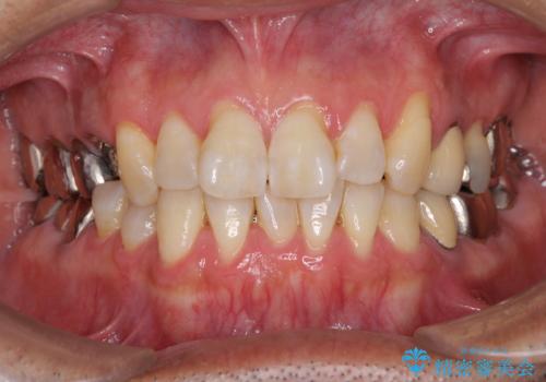 折れてしまった奥歯 インプラントによる補綴治療の治療前