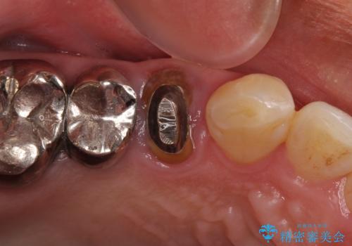 折れてしまった奥歯 インプラントによる補綴治療の治療前