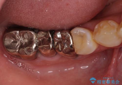 折れてしまった奥歯 インプラントによる補綴治療の治療前