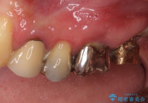 折れてしまった奥歯 インプラントによる補綴治療の治療前