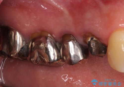 折れてしまった奥歯 インプラントによる補綴治療の治療前