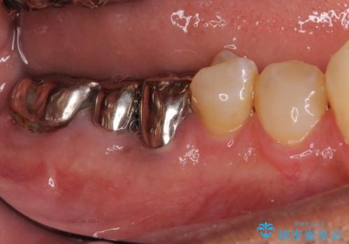 折れてしまった奥歯 インプラントによる補綴治療の治療前