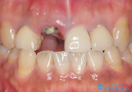 オールセラミッククラウン 折れてしまった前歯の治療の治療前