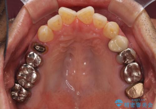 折れてしまった奥歯 インプラントによる補綴治療の治療前