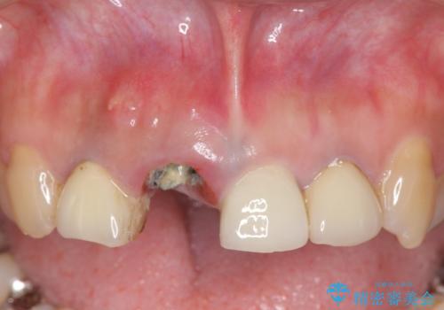 オールセラミッククラウン 折れてしまった前歯の治療の治療前