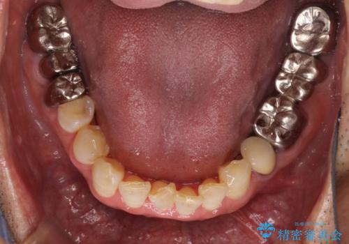 折れてしまった奥歯 インプラントによる補綴治療の治療前