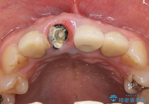 オールセラミッククラウン 折れてしまった前歯の治療の治療前