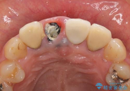 オールセラミッククラウン 折れてしまった前歯の治療の治療前