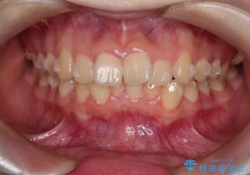 上下の前歯のガタガタを目立たず治したい　インビザラインによる見えない矯正の治療中
