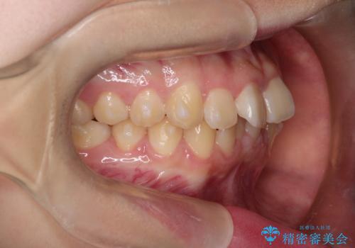 上下の前歯のガタガタを目立たず治したい インビザラインによる見えない矯正の治療中
