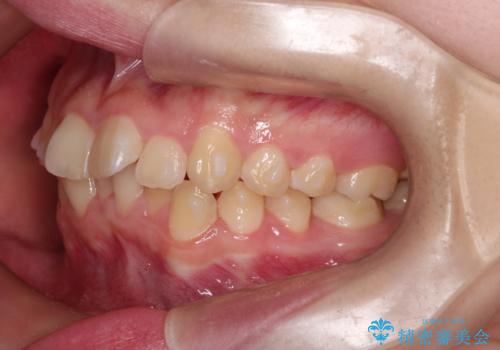 上下の前歯のガタガタを目立たず治したい インビザラインによる見えない矯正の治療中