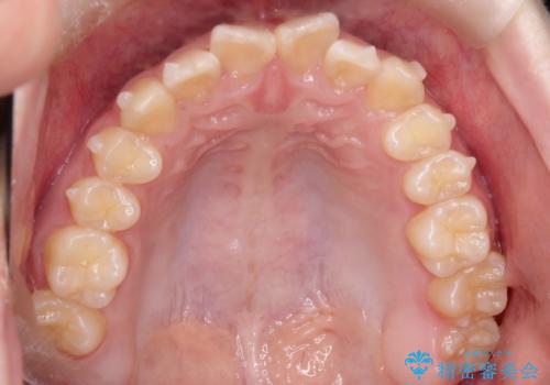 上下の前歯のガタガタを目立たず治したい インビザラインによる見えない矯正の治療中