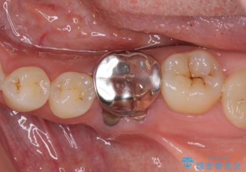 前歯のデコボコを治したい ワイヤー矯正の治療中